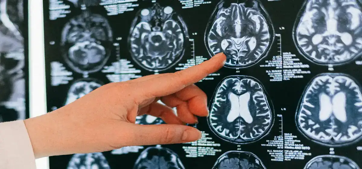 imagen de escaner cerebral posible caso de cisticercosis neurocisticercosis