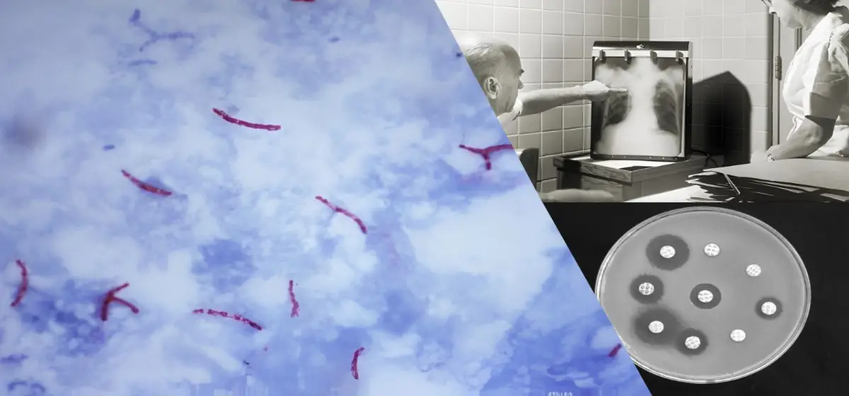 imagne de muestra de tuberculosis radiografia antibiograma