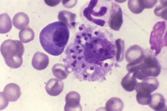 Leishmaniasis