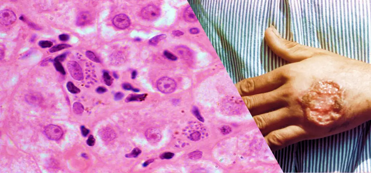 mano con leishmaniasis