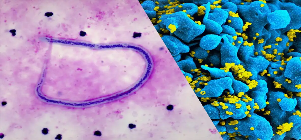 parasito-elefantiasis-filariasis-linfatica-virus-vih
