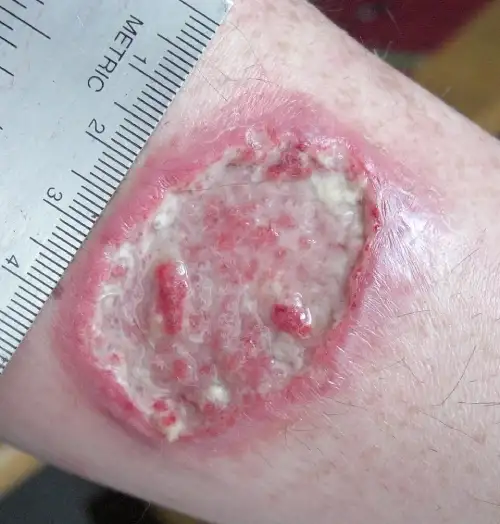 Leishmaniasis