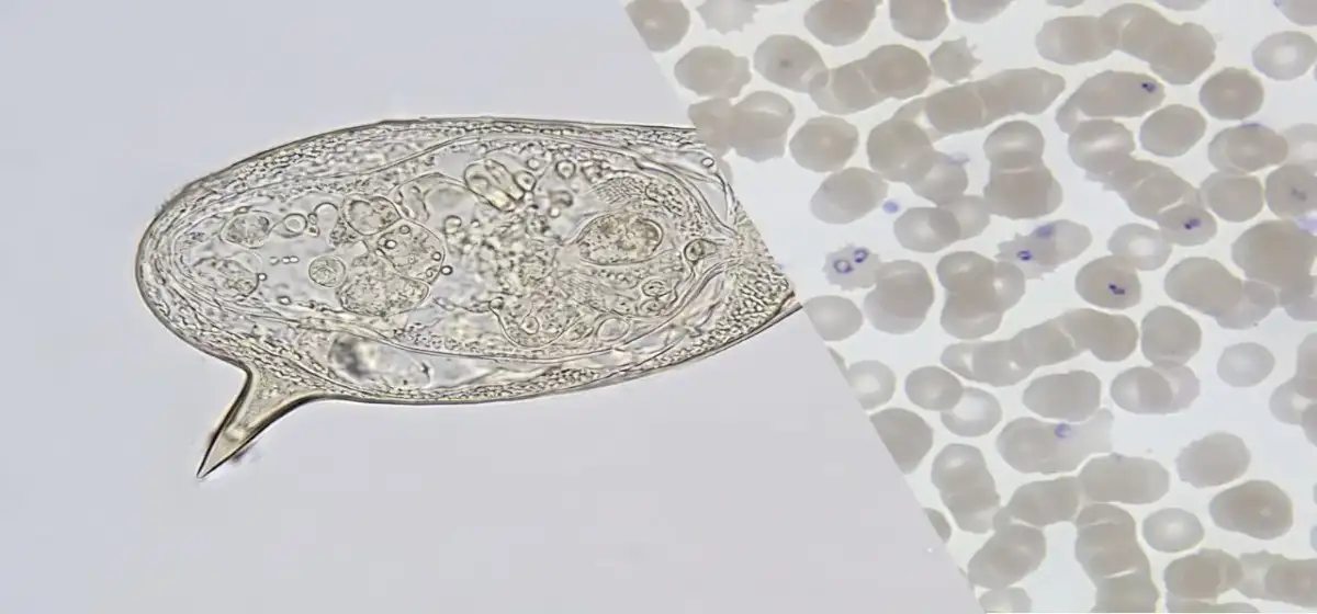 coinfección por malaria y esquistosomiasis